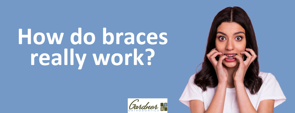 How Do Braces Work_- Gardner Orthodontics - Best orthodontist in Pahrump